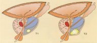 Prostat xərçəngi şübhəsi olanlar  - OXUSUNLAR