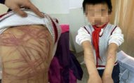 Ögey ana 9 yaşlı uşağın bədənində salamat yer qoymadı – FOTO