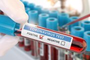Azərbaycanda daha 67 nəfər koronavirusa yoluxub, 2 nəfər ölüb 