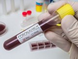 Azərbaycanda daha 75 nəfər koronavirusa yoluxdu, 25 nəfər sağaldı 