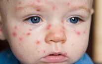 Uşaqlar arasında suçiçəyi xəstəliyi yayılıb - VİDEO