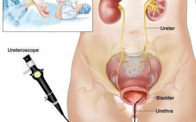 Böyrək daşlarının müalicəsində daha bir yenilik   – VİDEO