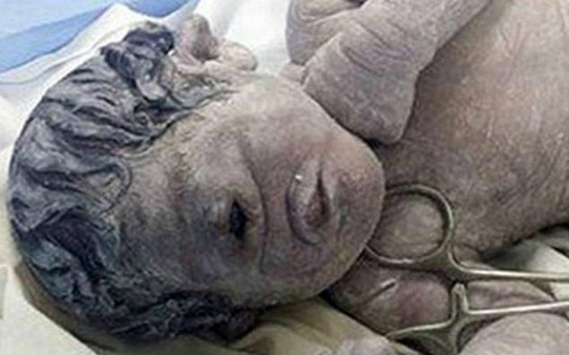 Şok: təpəgöz uşaq doğuldu