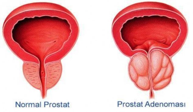 Prostat xəstəliklərindən əziyyət çəkənlər  - Görünməmiş yenilik