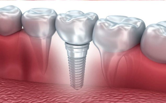 Diş implantı xərçəng yaradır?