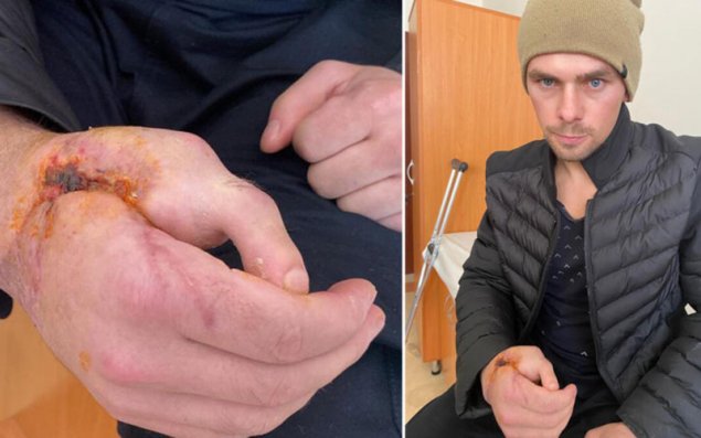 Kəsilmiş əl barmağının yerinə ayaq barmağı tikildi - VİDEO