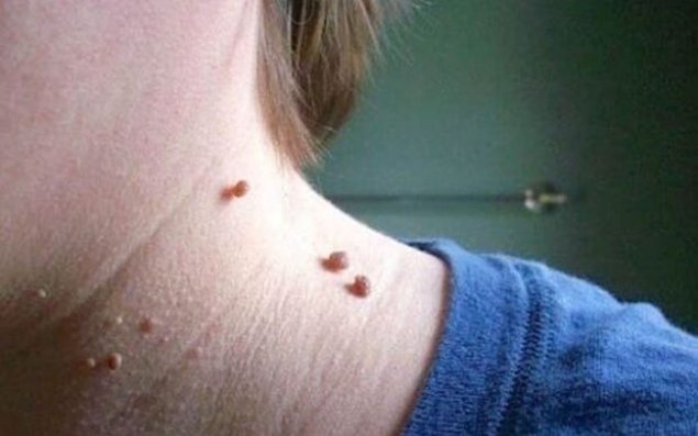 Üzümüzdə olan xallar nədən xəbər verir?